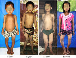 Case Report: Children with Severe Nutritional Rickets in the Naga Region in Northwest Myanmar, on the border with India in: The American Journal of Tropical Medicine and Hygiene Volume 105 Issue 1 (2021)