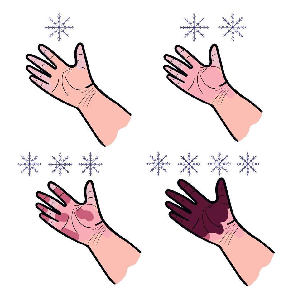 set of four hand drawings on a white background stage of frostbite vector illustration 21967276 Vector Art at Vecteezy